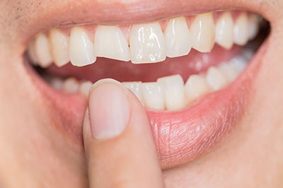 Granger Dentistry | Laser Dentistry, Crowns  amp  Caps and Full Mouth Reconstruction