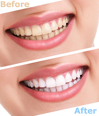 Granger Dentistry | Full Mouth Reconstruction, Crowns  amp  Caps and Dental Cleanings
